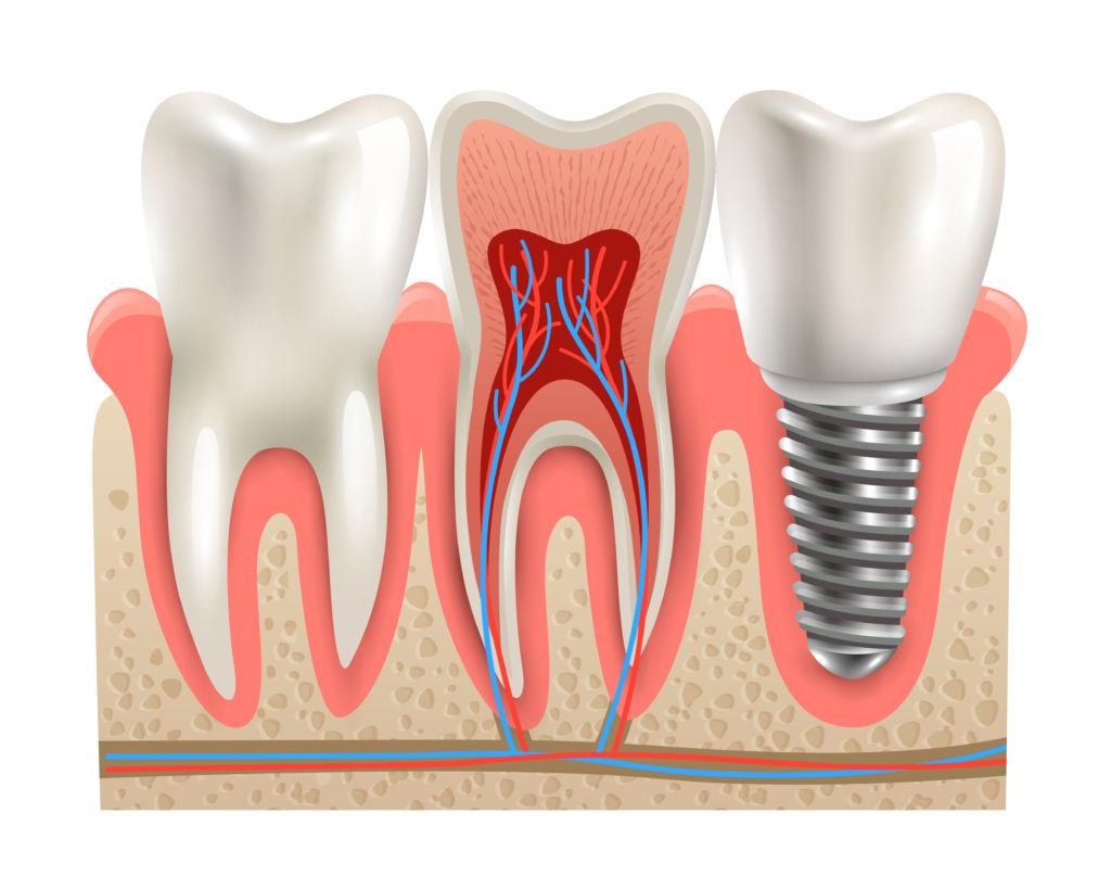 Dental implants in Hyderabad