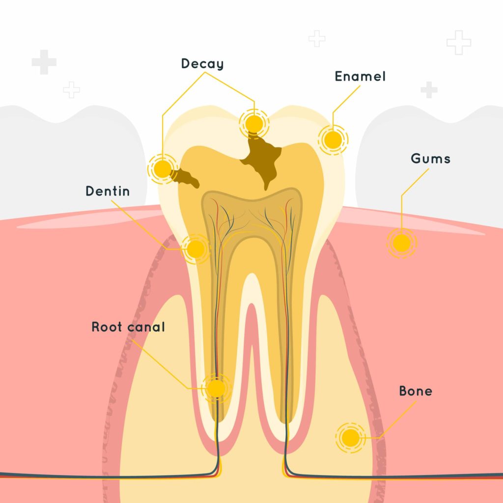 Root canal treatment in Hyderabad