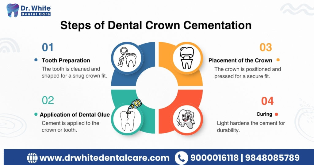 Steps of Dental Crown Cementation