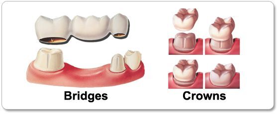 Dental Crowns and Bridges Treatment in Hyderabad
