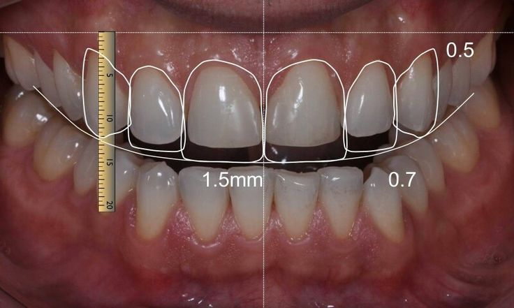 Smile Makeover Treatment in Hyderabad