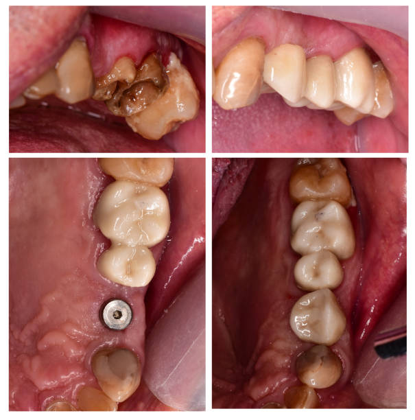 Dental Implants in Hyderabad
