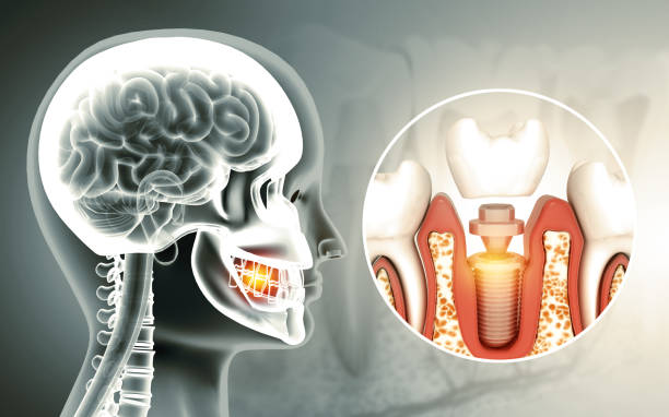 Dental Implants in Hyderabad