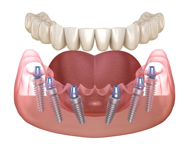 Dental Implants in Hyderabad