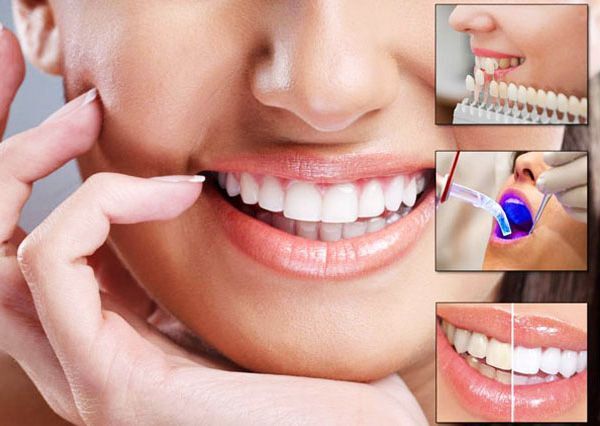 Smile Makeover Treatment in Hyderabad