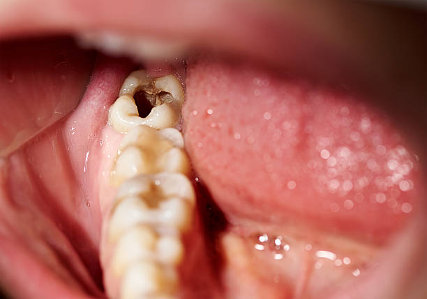 Pediatric Dentist in Hyderabad