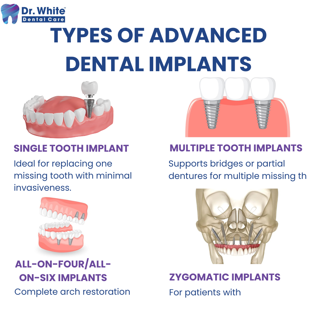 Dental Implants in Hyderabad