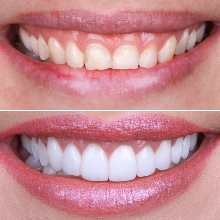 Smile Makeover Treatment in Hyderabad