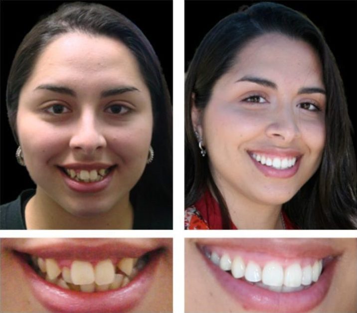 Invisalign Providers in Nizampet