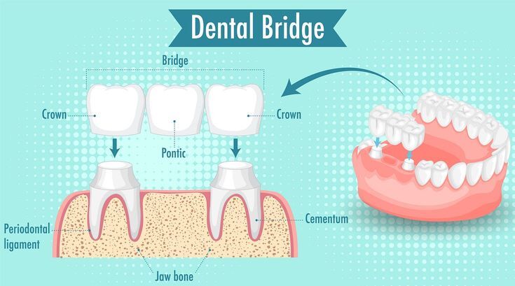 Dental Crowns and Bridges Treatment in Hyderabad