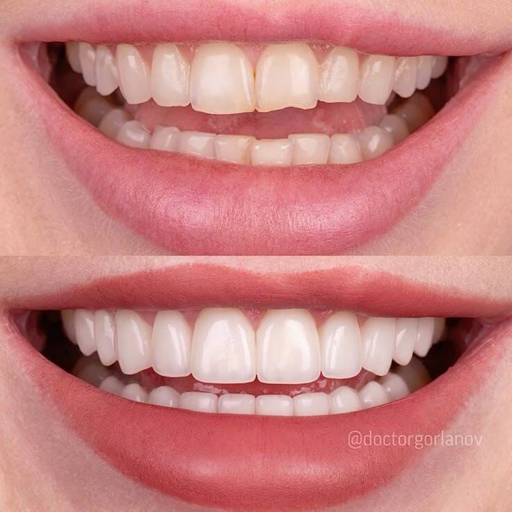 Invisalign Providers in Nizampet