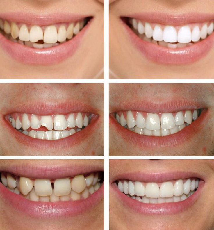 Invisalign Providers in Nizampet