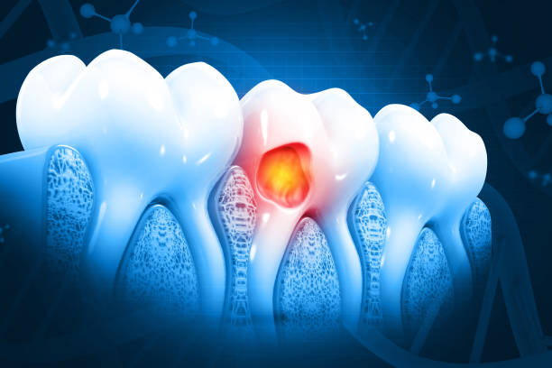 Dental Fillings in Hyderabad