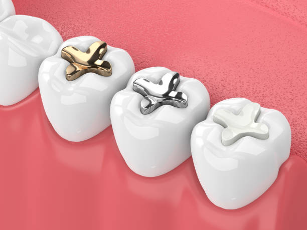 Dental Fillings in Hyderabad
