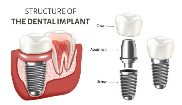 Dental Implants in Hyderabad