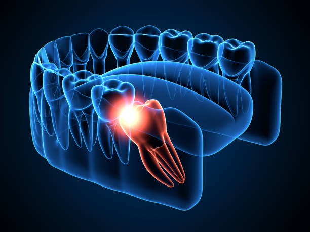 Wisdom Tooth Removal in Hyderabad