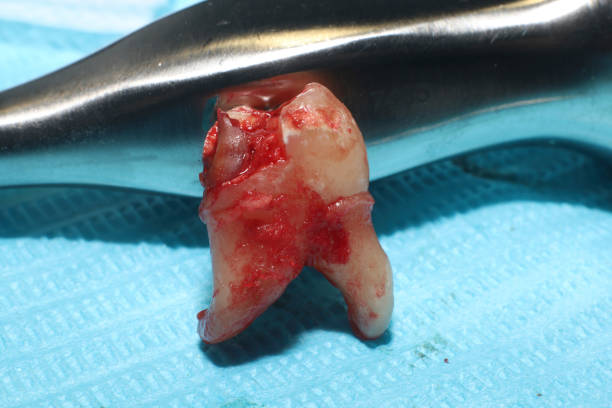 Wisdom Tooth Removal in Hyderabad