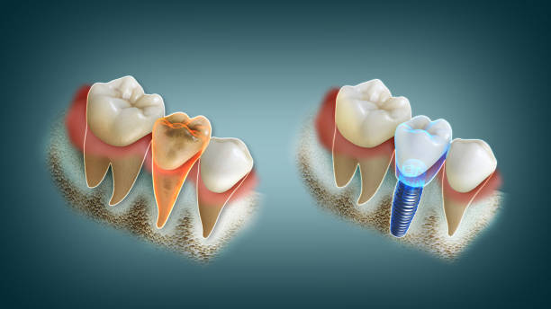 Dental Implants in Madinaguda