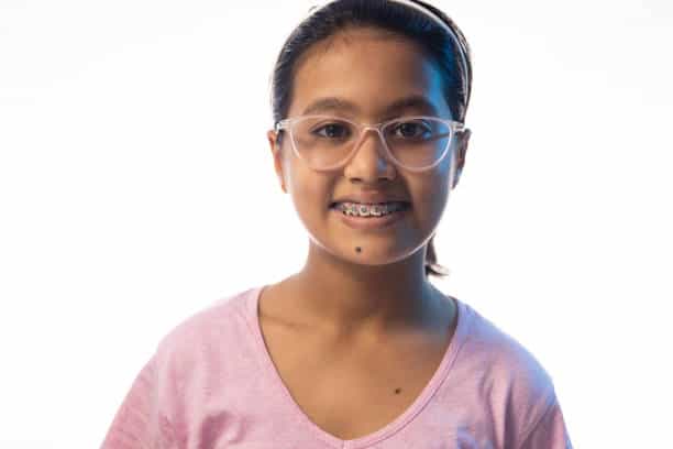 Teeth Braces Before and After