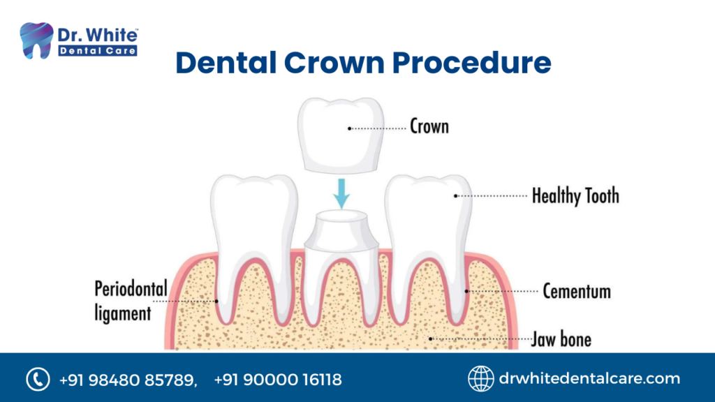Complete-Guide-to-Dental-Glue-for-Crowns.png
