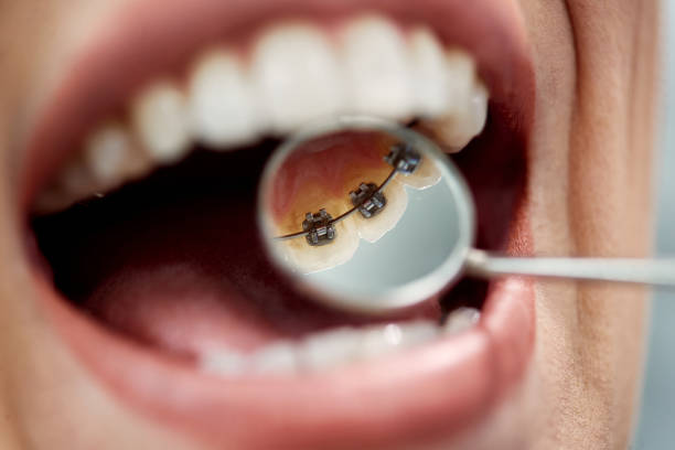 Dental Braces Treatment in Nizampet
