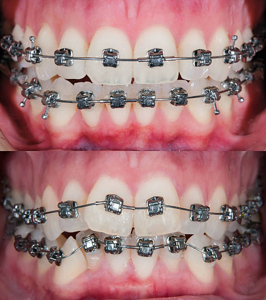 Dental Braces Treatment in Nizampet