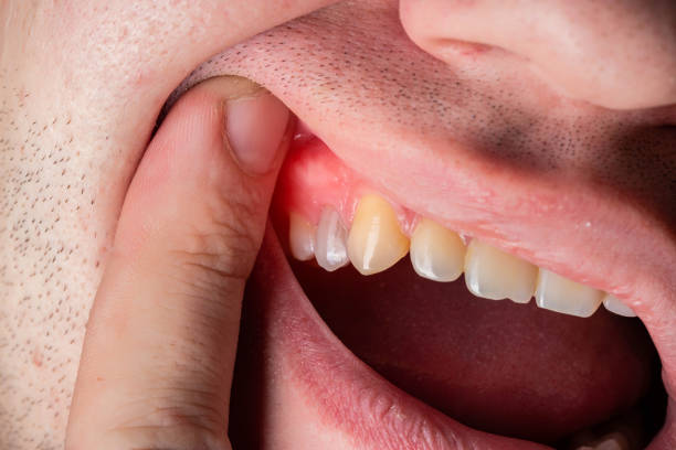 Best Gum Specialist in Hyderabad