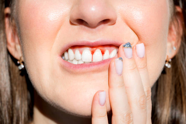 Gum Disease Treatment in Nizampet