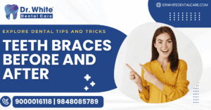 Teeth Braces Before and After