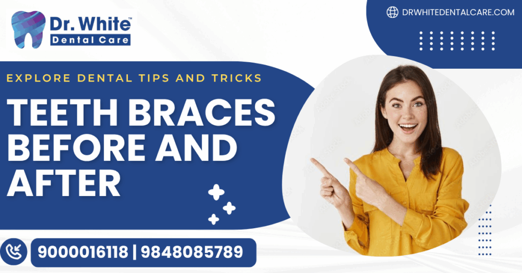 teeth braces before and after