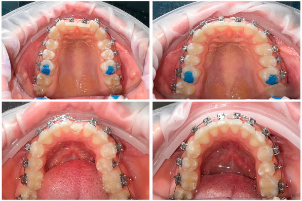 Teeth Braces Before and After
