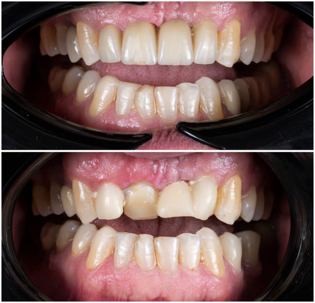 Teeth Braces Before and After