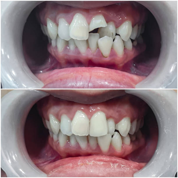 teeth braces before and after