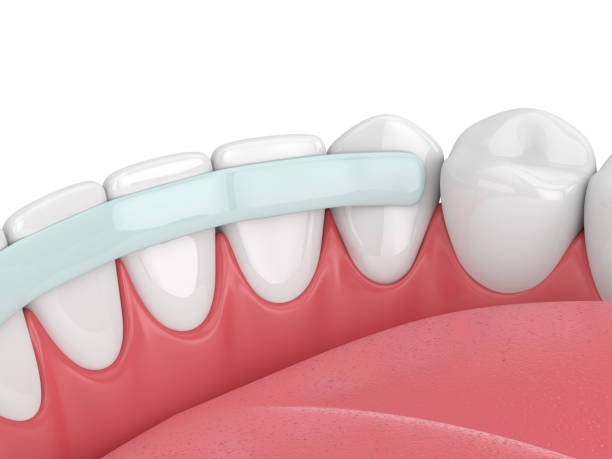 Dental Crowns and Bridges