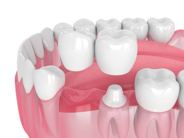Dental Crowns and Bridges Treatment in Nizampet