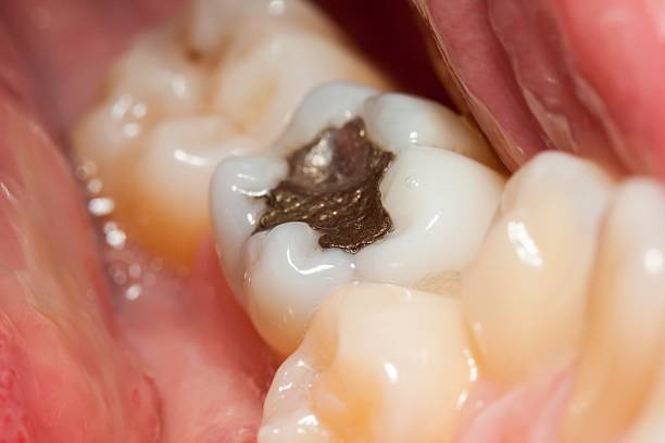 Dental Fillings in Hyderabad