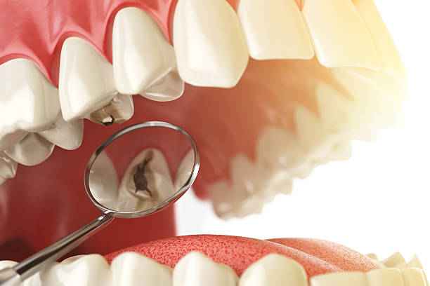 Dental Fillings in Hyderabad