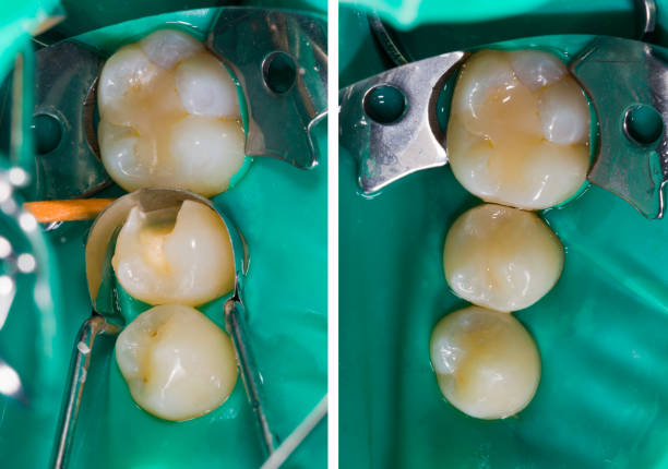 Dental Fillings in Hyderabad