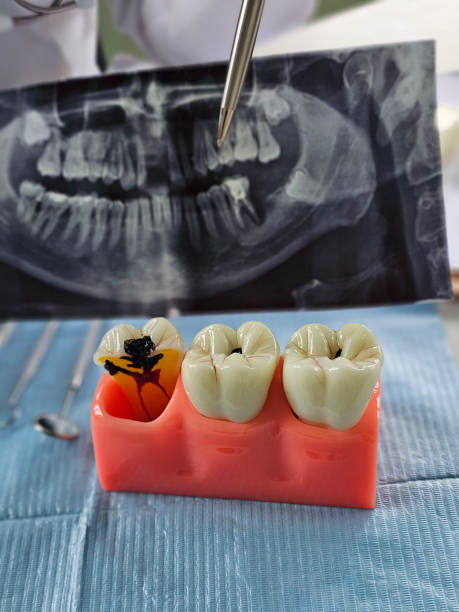 Dental Fillings in Hyderabad