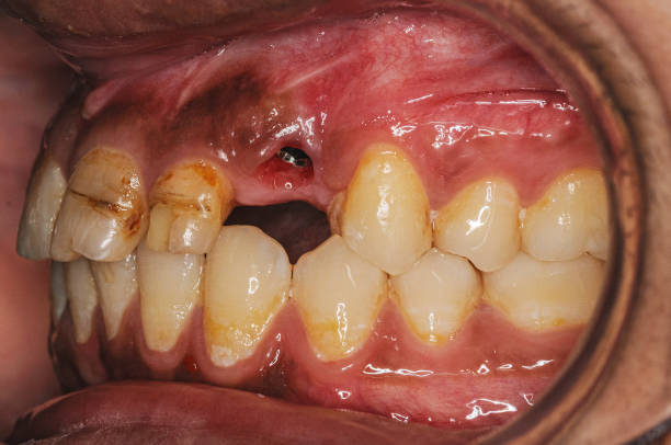 Dental Implants in Hyderabad