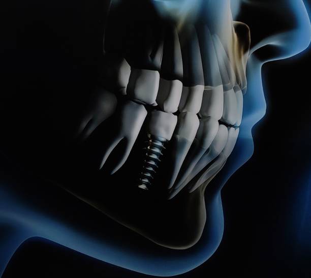 Dental Implants in Hyderabad