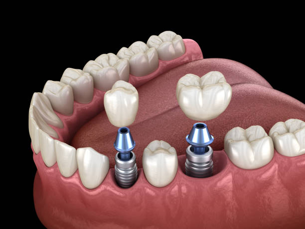 Dental Implants in Hyderabad