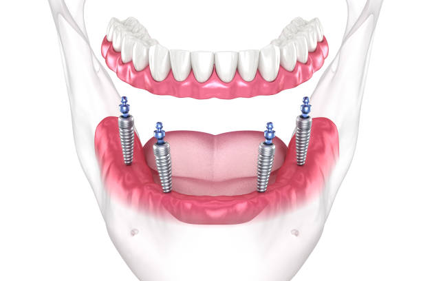 Dental Implants in Hyderabad