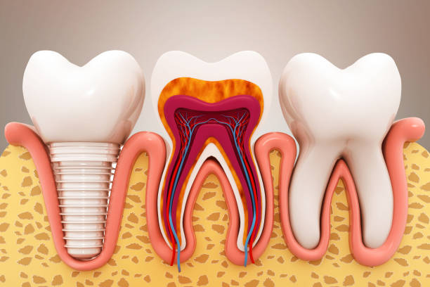 Dental Implants in Hyderabad