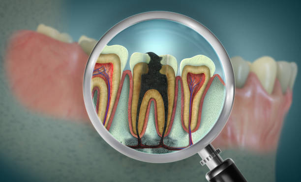 Root Canal Treatment in Nizampet