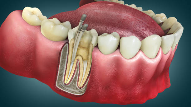 Root Canal Treatment in Nizampet