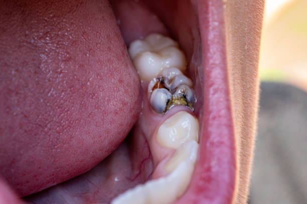 Root Canal Treatment in Nizampet