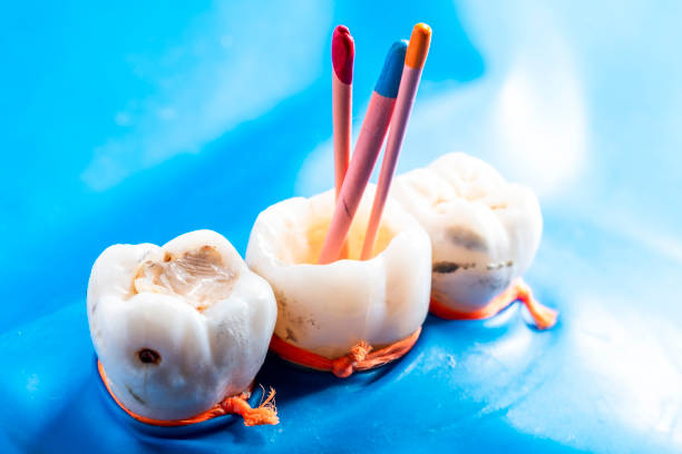 Root Canal Treatment in Madinaguda