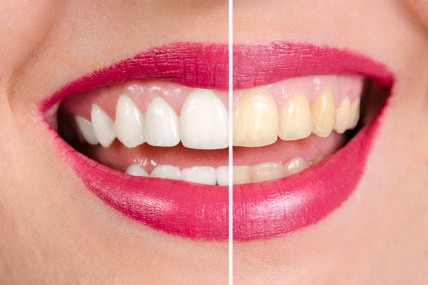 Smile Makeover Treatment in Hyderabad