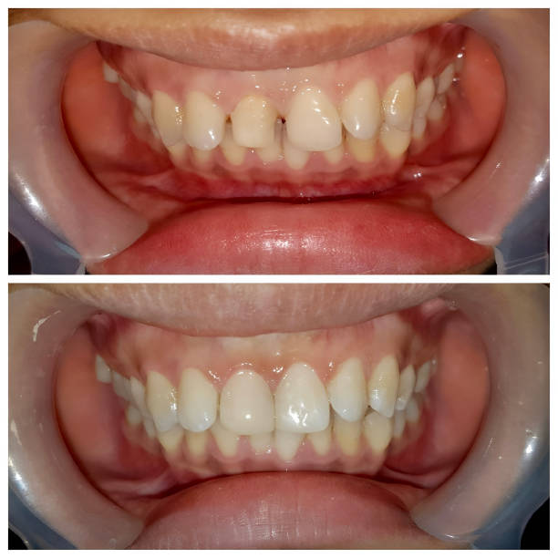 Smile Makeover Treatment in Nizampet